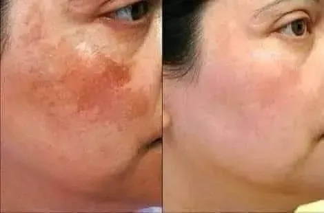 Angel melasma Cream